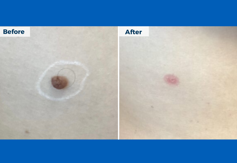 Mole removal B&A 2-1