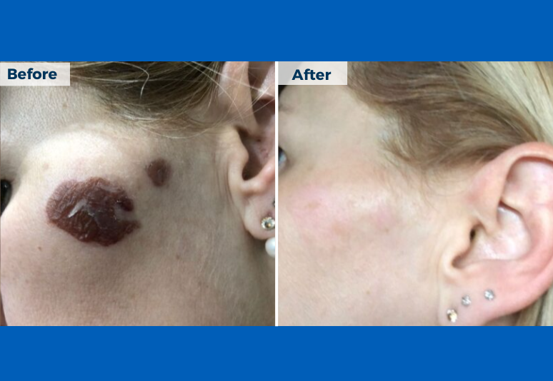 Mole removal B&A 3