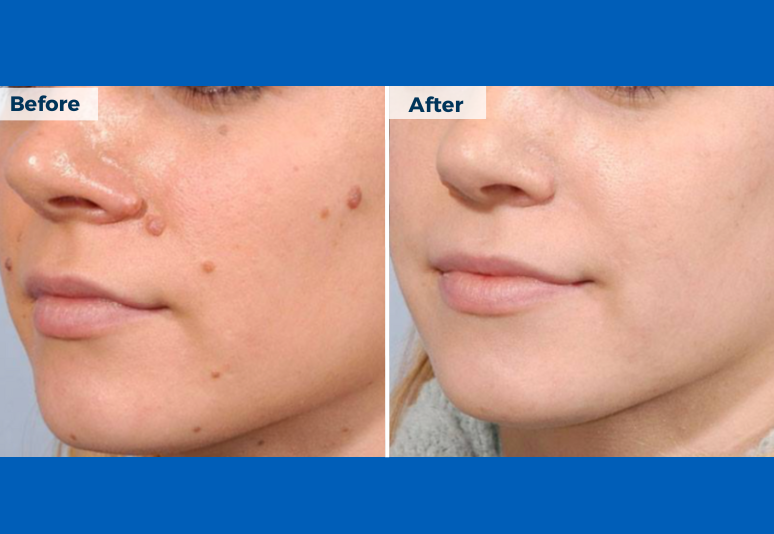 Mole removal B&A 4