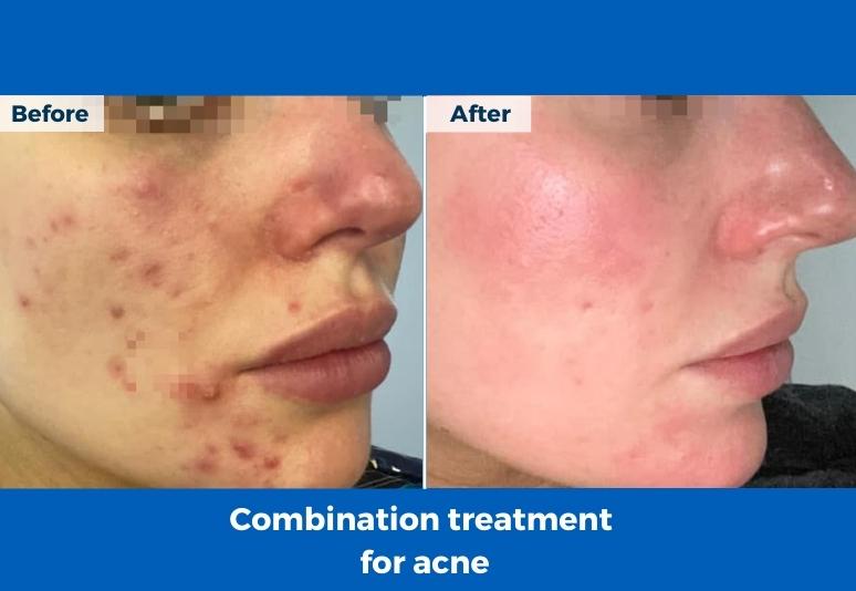 New Town - Acne Treatment B&A 1-2