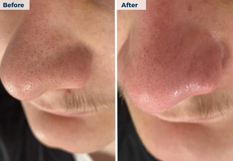 New Town - Hydrafacial 2 B&A