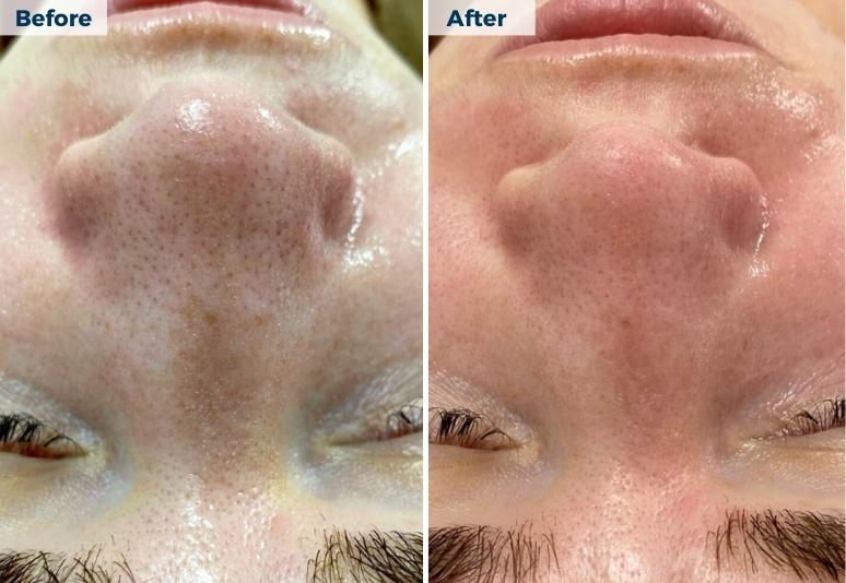 New Town - Hydrafacial 3 B&A