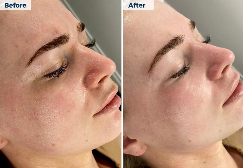 New Town - Hydrafacial 4 B&A