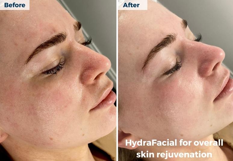 New Town - Hydrafacial new town
