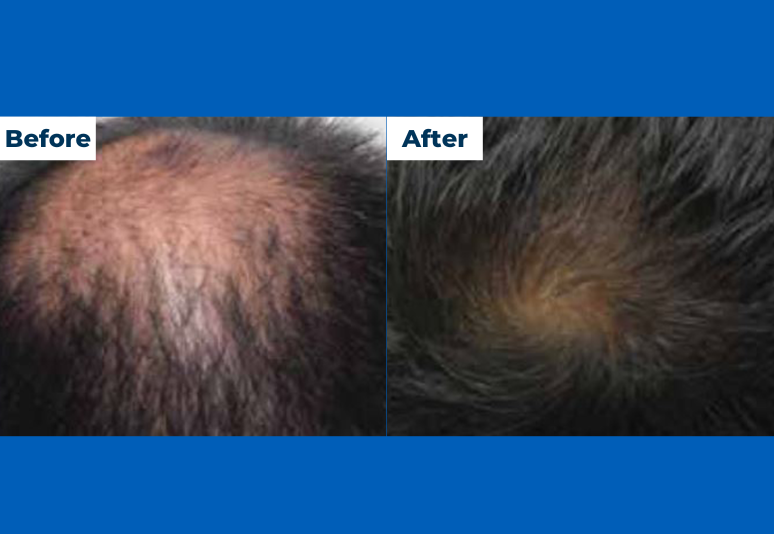 PRP hair loss