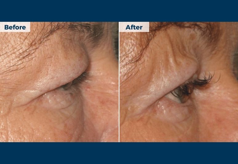 Plasma Pen Skin Tightening B&A (2)