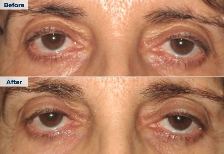 Plasma Pen Skin Tightening B&A (3)-1