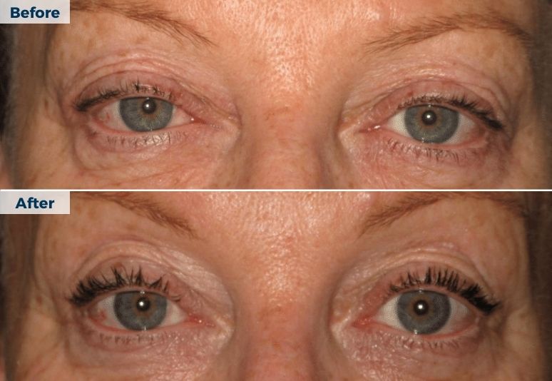 Plasma Pen Skin Tightening B&A (4)