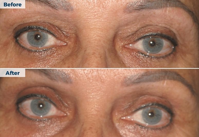 Plasma Pen Skin Tightening B&A (7)