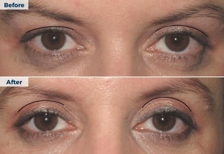 Plasma Pen Skin Tightening B&A (8)