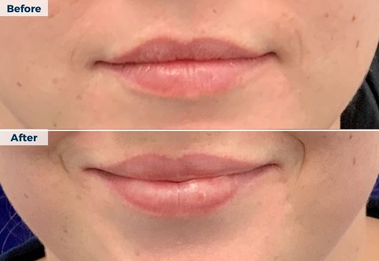 Dermal Fillers B&A  (2)