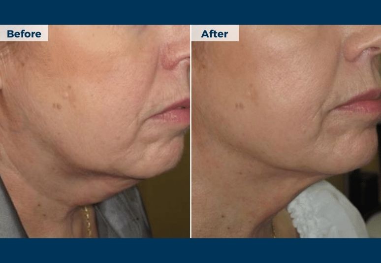 Lipodissolve B&A (4)