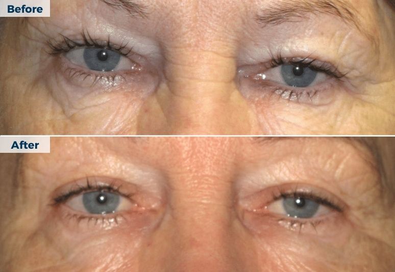 Plasma Pen Skin Tightening B&A (5)