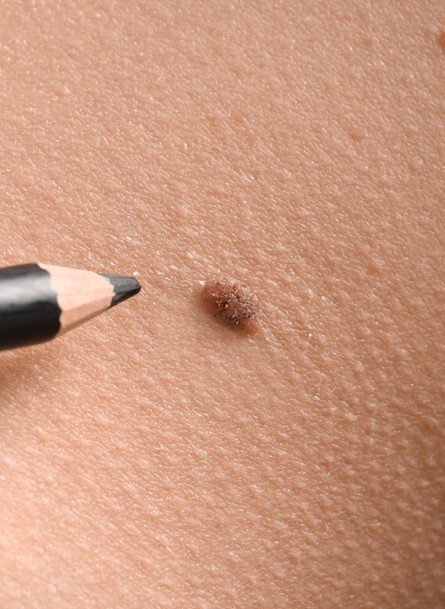 Mole removal Skin Clinic, Australia