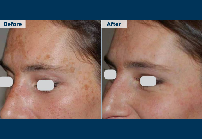 Non ablative laser B&A 4