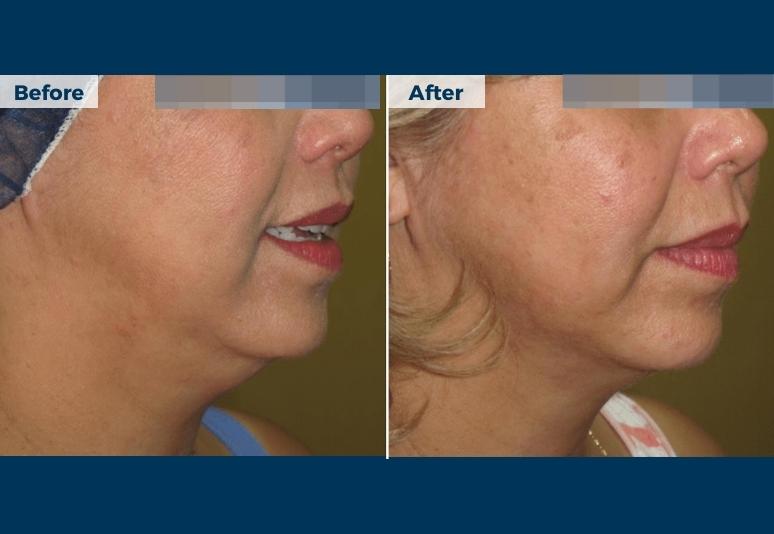 Fat dissolving injections2 B&A