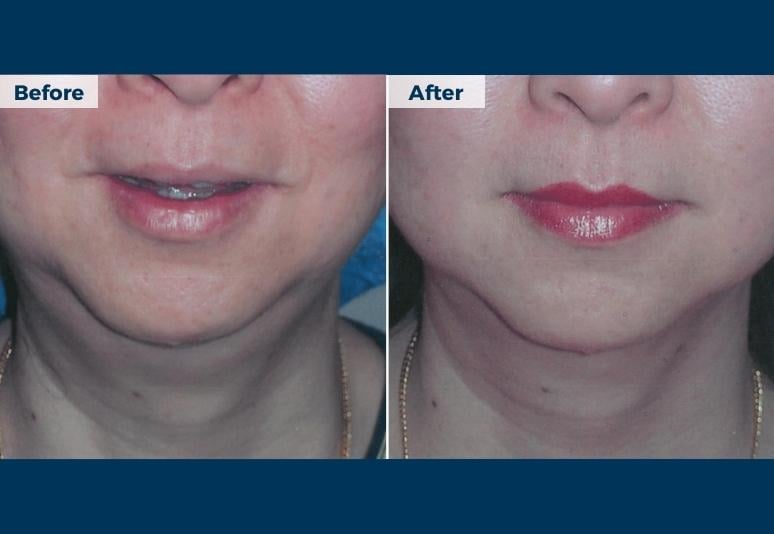 Fat dissolving injections3 B&A
